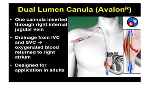 Femoro-Femoral:
• Access cannula is inserted via
the femoral vein with the tip sited
within the ivc.
• Return cannula is i...