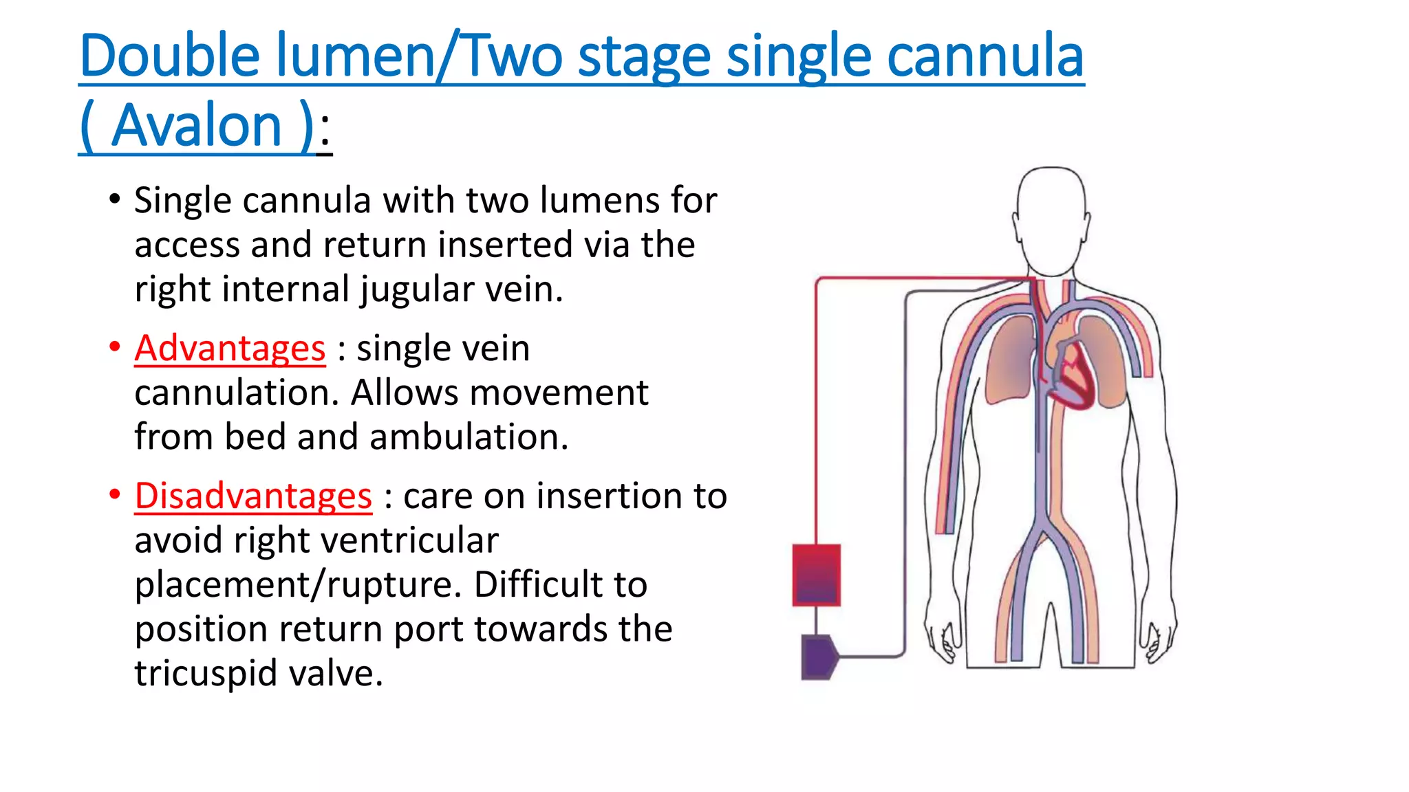 Double lumen/Two stage single cannula
( Avalon ):
• Single cannula with two lumens for
access and return inserted via the
right internal jugular vein.
• Advantages : single vein
cannulation. Allows movement
from bed and ambulation.
• Disadvantages : care on insertion to
avoid right ventricular
placement/rupture. Difficult to
position return port towards the
tricuspid valve.
 