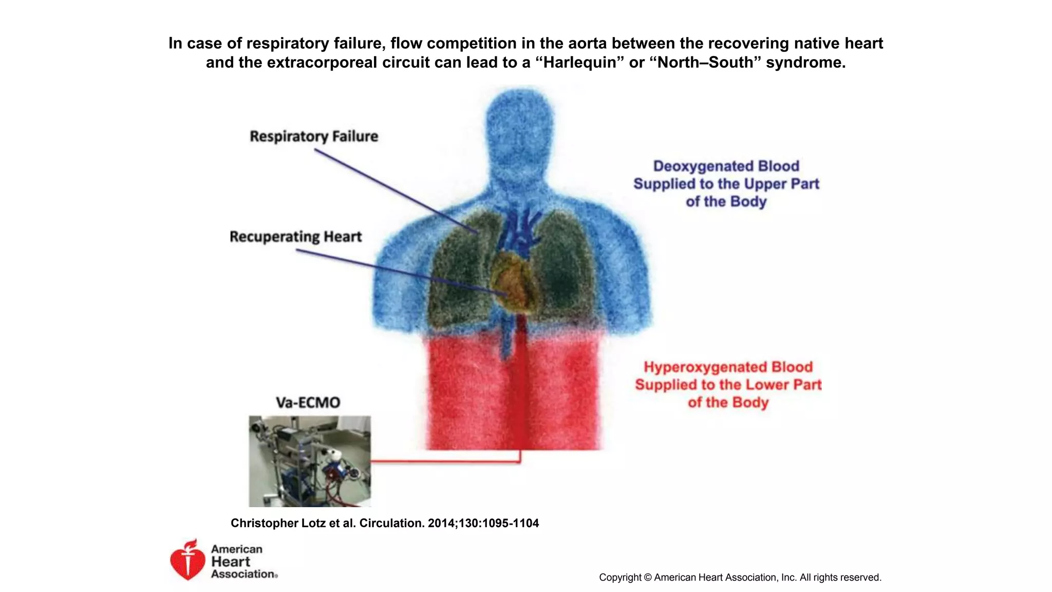 In case of respiratory failure, flow competition in the aorta between the recovering native heart
and the extracorporeal circuit can lead to a “Harlequin” or “North–South” syndrome.
Christopher Lotz et al. Circulation. 2014;130:1095-1104
Copyright © American Heart Association, Inc. All rights reserved.
 