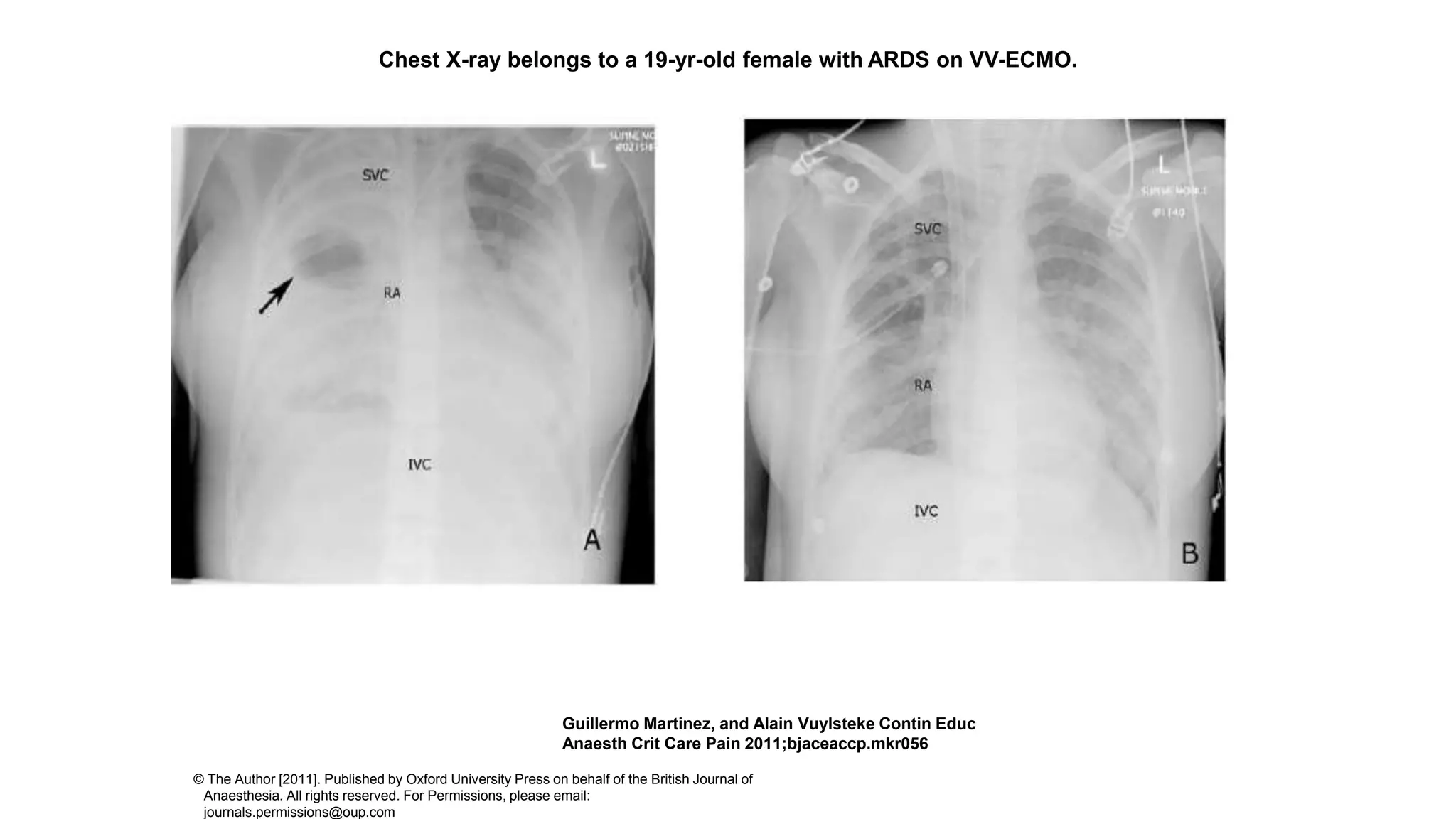 Chest X-ray belongs to a 19-yr-old female with ARDS on VV-ECMO.
Guillermo Martinez, and Alain Vuylsteke Contin Educ
Anaesth Crit Care Pain 2011;bjaceaccp.mkr056
© The Author [2011]. Published by Oxford University Press on behalf of the British Journal of
Anaesthesia. All rights reserved. For Permissions, please email:
journals.permissions@oup.com
 