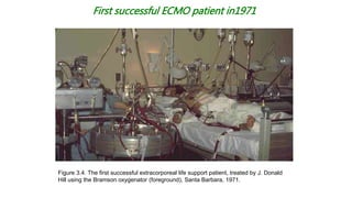 First successful ECMO patient in1971
Figure 3.4. The first successful extracorporeal life support patient, treated by J. Donald
Hill using the Bramson oxygenator (foreground), Santa Barbara, 1971.
 
