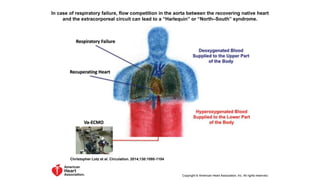 In case of respiratory failure, flow competition in the aorta between the recovering native heart
and the extracorporeal circuit can lead to a “Harlequin” or “North–South” syndrome.
Christopher Lotz et al. Circulation. 2014;130:1095-1104
Copyright © American Heart Association, Inc. All rights reserved.
 