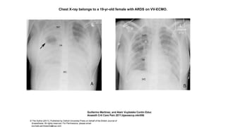 Chest X-ray belongs to a 19-yr-old female with ARDS on VV-ECMO.
Guillermo Martinez, and Alain Vuylsteke Contin Educ
Anaesth Crit Care Pain 2011;bjaceaccp.mkr056
© The Author [2011]. Published by Oxford University Press on behalf of the British Journal of
Anaesthesia. All rights reserved. For Permissions, please email:
journals.permissions@oup.com
 