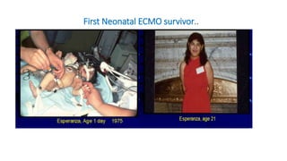 First Neonatal ECMO survivor..
 