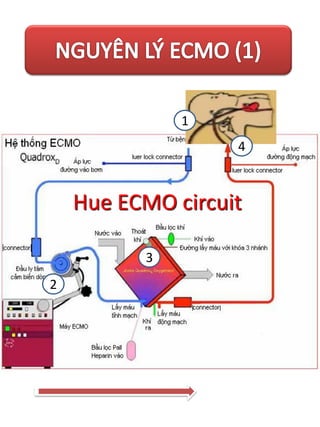 Ecmo for intraoperative cardiac support in children with congenital ...