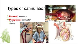 Types of cannulation
v Central cannulation
vPeripheral cannulation
vNeck
vfemoral
 