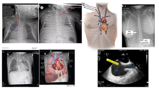 Ecmo history, indications, cannulation, complications