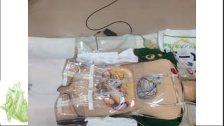 Ecmo history, indications, cannulation, complications