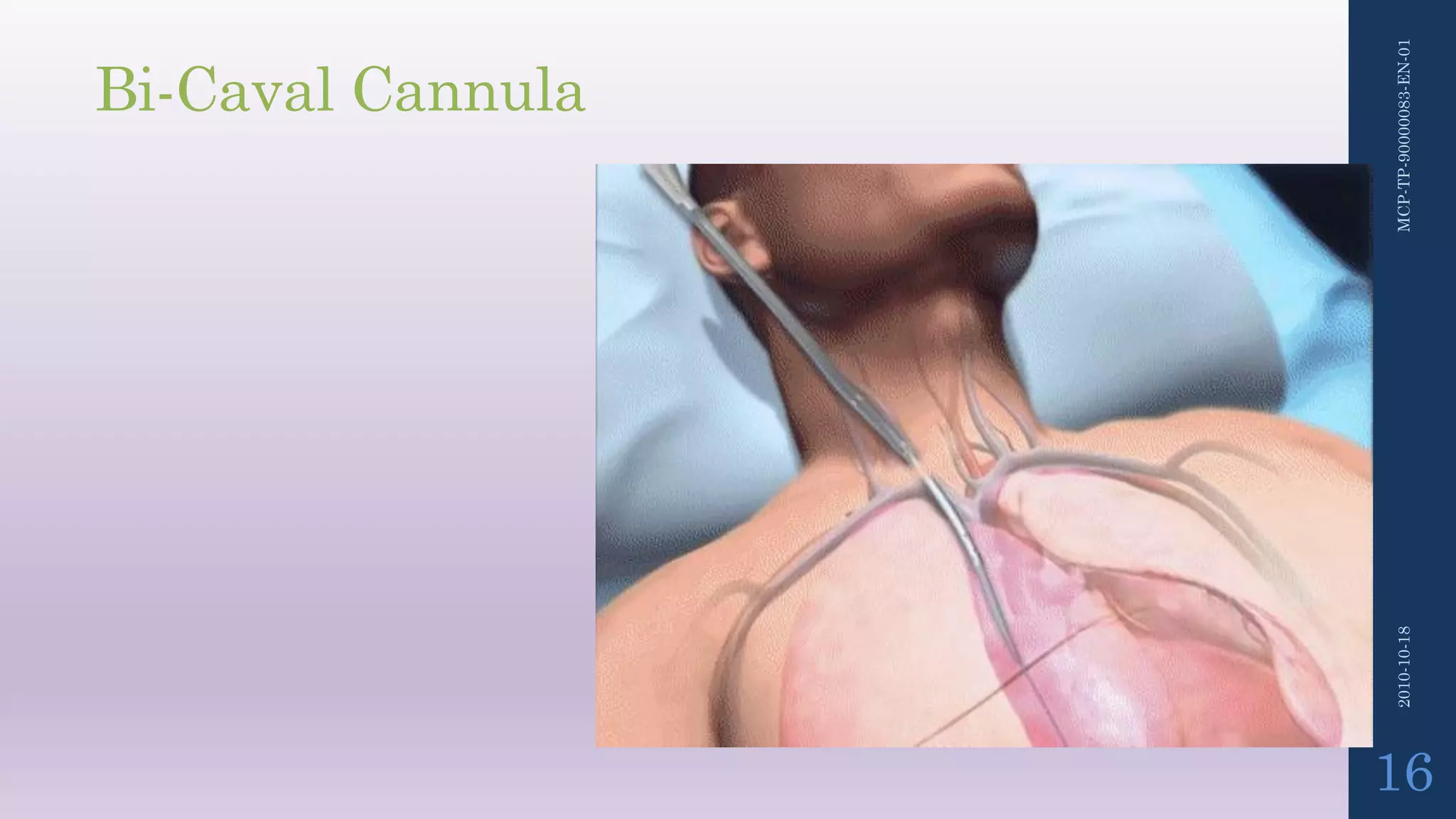 MCP-TP-90000083-EN-012010-10-18
16
Bi-Caval Cannula
 