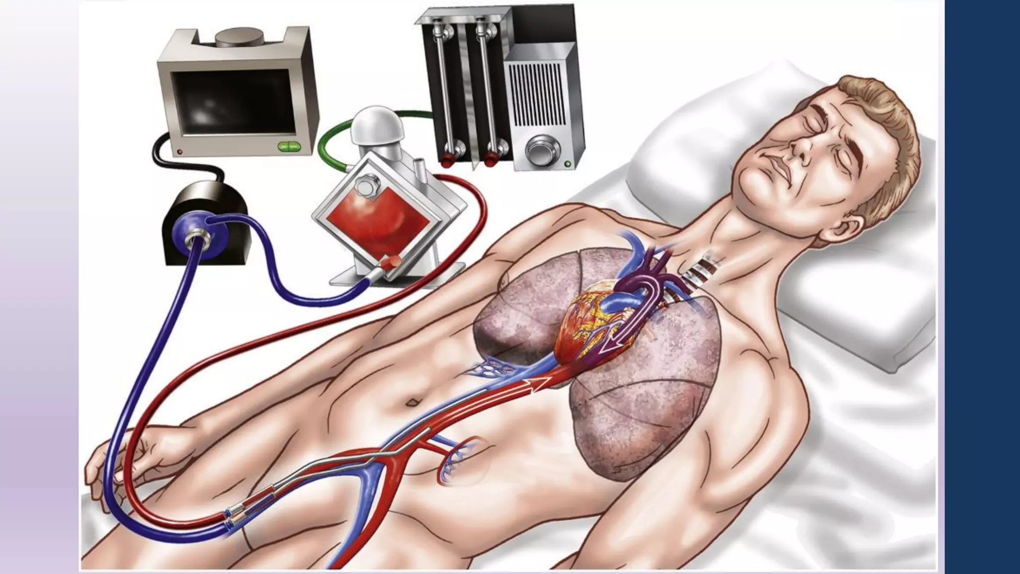Date of download:
1/7/2015
Copyright © The American College of Cardiology.
All rights reserved.
From: Extracorporeal Membrane Oxygenation in Cardiopulmonary Disease in Adults
J Am Coll Cardiol. 2014;63(25_PA):2769-2778. doi:10.1016/j.jacc.2014.03.046
Femoral Venoarterial ECMO
When extracorporeal membrane oxygenation (ECMO) is implemented via femoral venous drainage and femoral arterial return in
patients with residual native cardiac function and impaired lung function, reinfused oxygenated blood (red arrow), flowing
retrograde through the aorta, may meet resistance from poorly oxygenated blood flowing antegrade from the left ventricle (purple
arrow). Depending on the amount of cardiac function, the location of the interface between antegrade and retrograde flow will vary,
and the reinfused oxygenated blood may not reach the cerebral and coronary vascular beds.
Figure Legend:
 