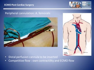 Ecmo Post Cardiac Surgery | PDF
