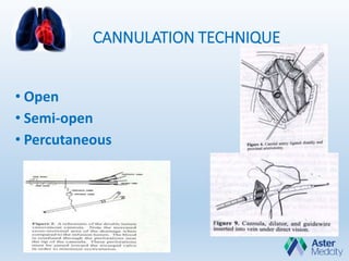 CANNULATION TECHNIQUE
• Open
• Semi-open
• Percutaneous
 