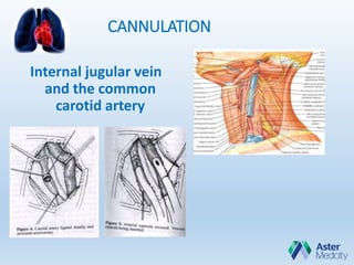 CANNULATION
Internal jugular vein
and the common
carotid artery
 