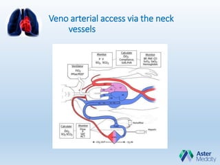 Veno arterial access via the neck
vessels
 