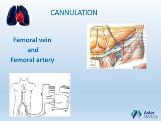 CANNULATION
Femoral vein
and
Femoral artery
 