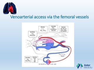 Venoarterial access via the femoral vessels
 