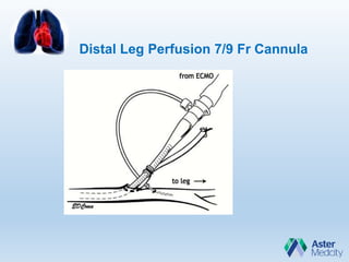 Distal Leg Perfusion 7/9 Fr Cannula
 