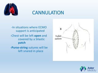 CANNULATION
-In situations where ECMO
support is anticipated
-Chest will be left open and
covered by a Silastic
patch
-Purse-string sutures will be
left snared in place
 