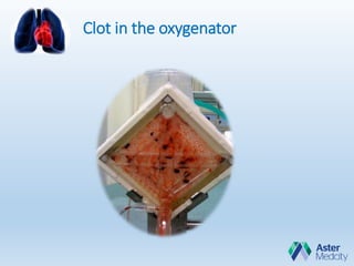 Clot in the oxygenator
 