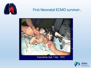 First Neonatal ECMO survivor..
 