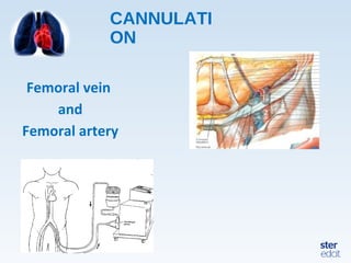 CANNULATI
ON
Femoral vein
and
Femoral artery
 