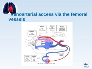 Venoarterial access via the femoral
vessels
 