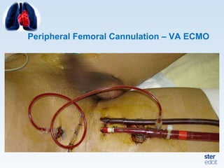 Peripheral Femoral Cannulation – VA ECMO
 