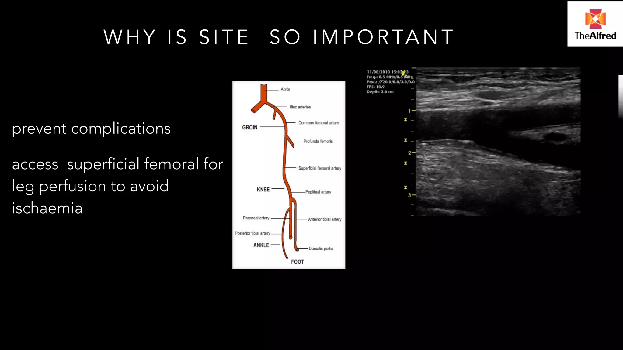 WHY IS SITE SO IMPORTANT 
prevent complications 
access superficial femoral for 
leg perfusion to avoid 
ischaemia 
 