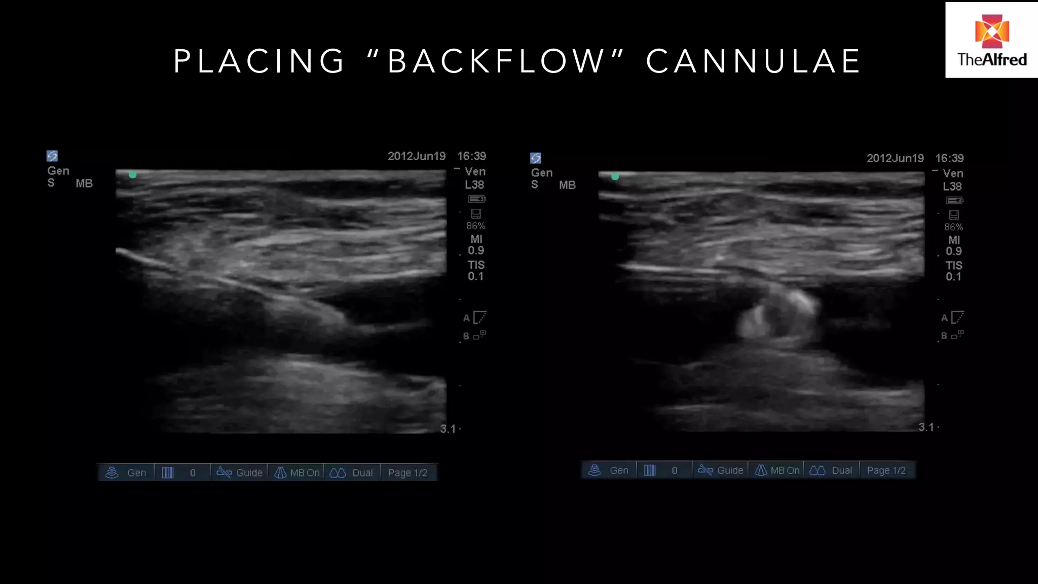 PLACING “BACKFLOW” CANNULAE 
 