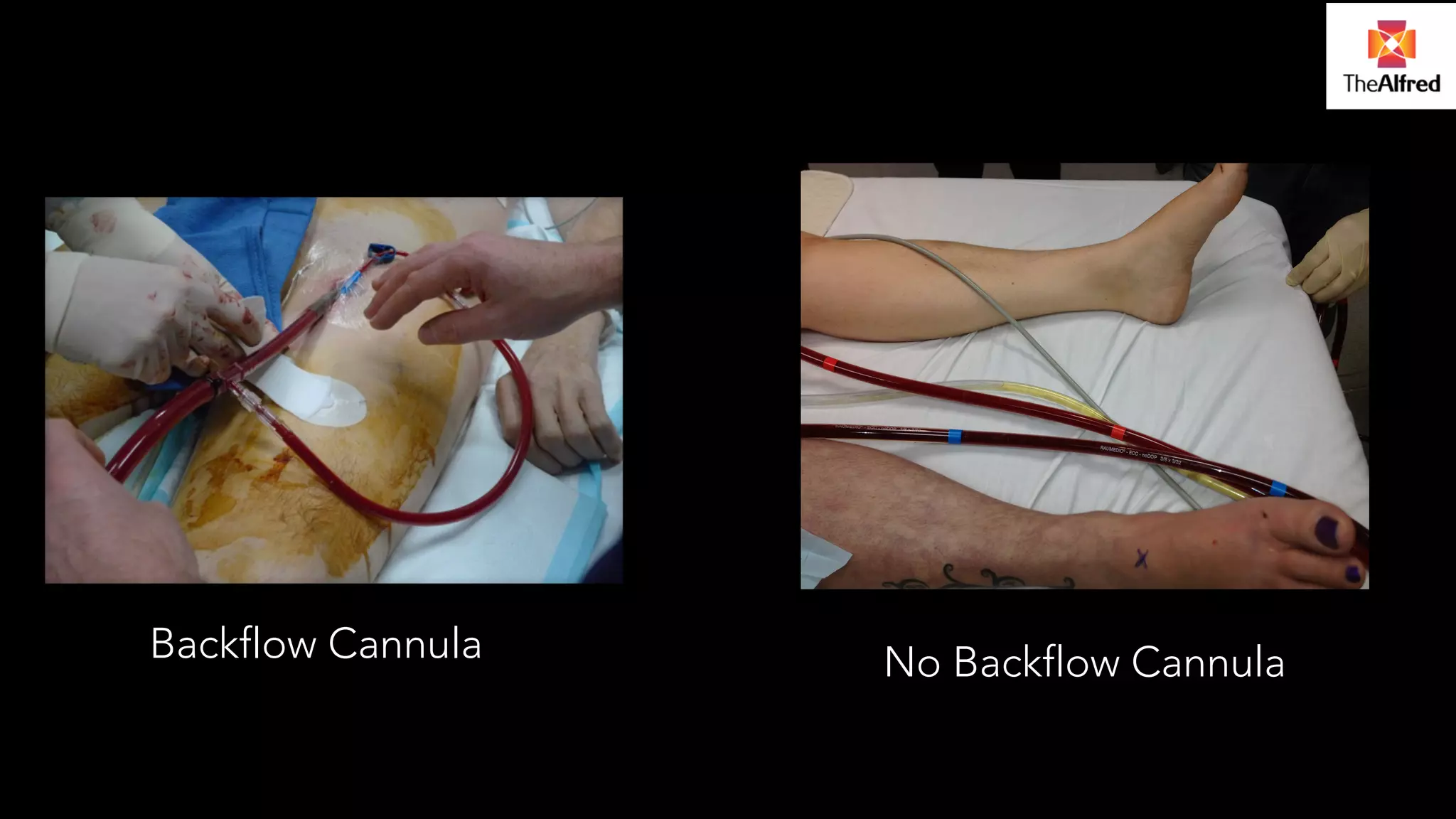 Backflow Cannula No Backflow Cannula 
 