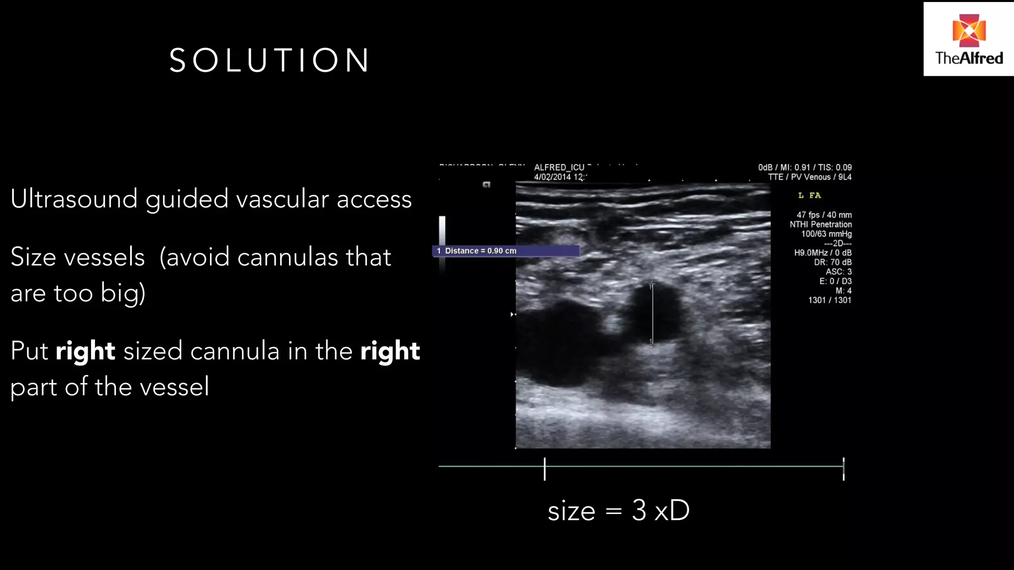 SOLUTION 
Ultrasound guided vascular access 
Size vessels (avoid cannulas that 
are too big) 
Put right sized cannula in the right 
part of the vessel 
size = 3 xD 
 