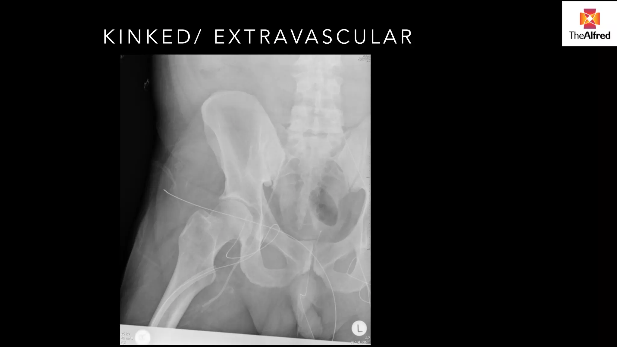 KINKED/ EXTRAVASCULAR 
 