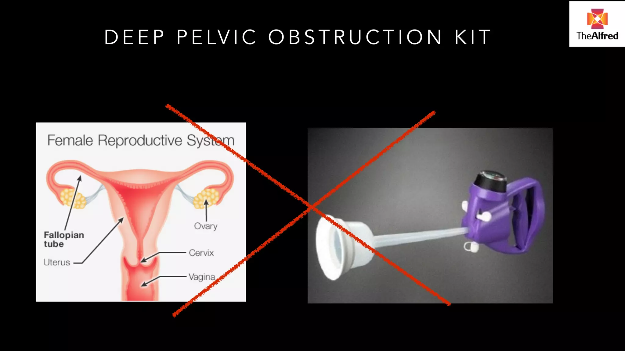 DEEP PELVIC OBSTRUCTION KIT 
 
