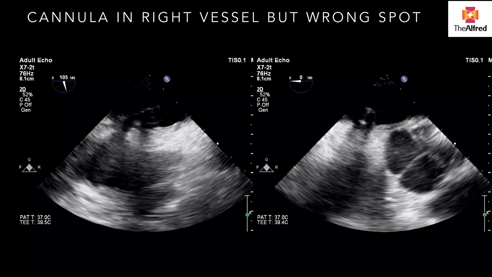 CANNULA IN RIGHT VESSEL BUT WRONG SPOT 
 