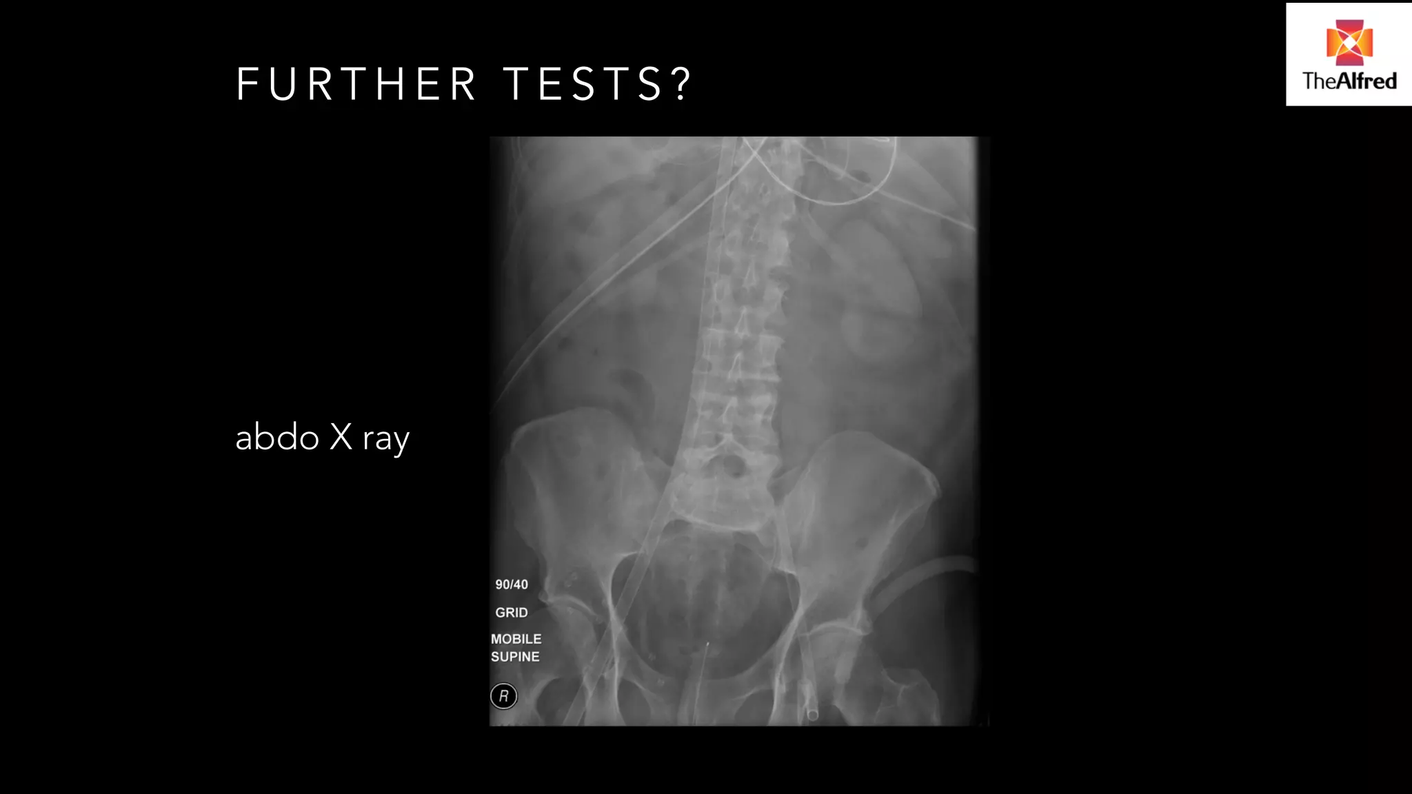 FURTHER TESTS? 
abdo X ray 
 