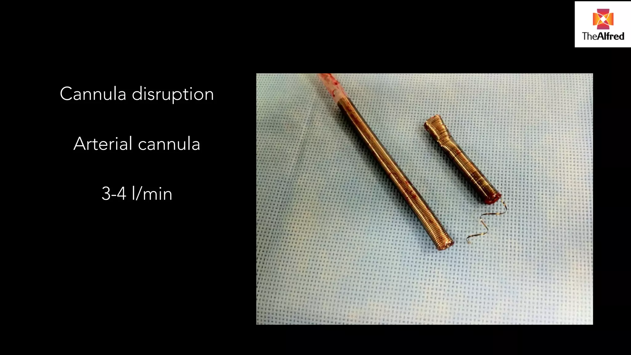 Cannula disruption 
! 
Arterial cannula 
! 
3-4 l/min 
 