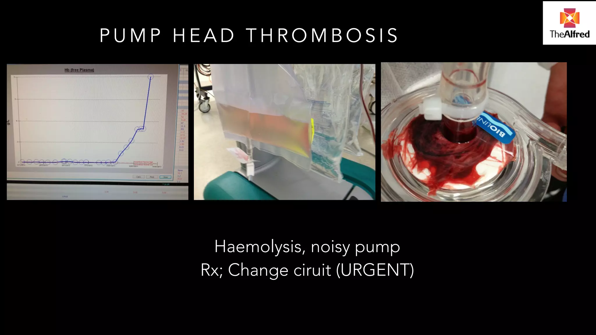 PUMP HEAD THROMBOSIS 
Haemolysis, noisy pump 
Rx; Change ciruit (URGENT) 
 