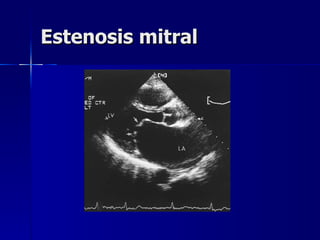 Estenosis mitral 