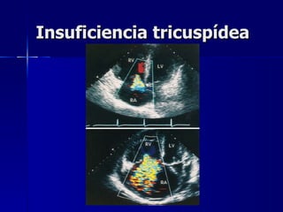 Insuficiencia tricuspídea 