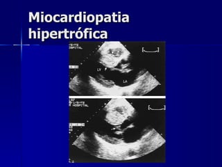 Miocardiopatia hipertrófica 