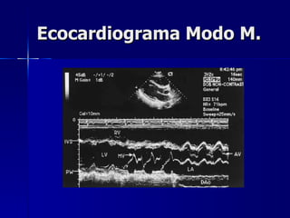 Ecocardiograma Modo M. 