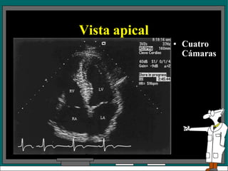 Vista apical
• Cuatro
Cámaras
 
