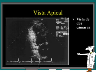 Vista Apical
• Vista de
dos
cámaras
 