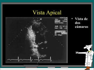 Vista Apical Vista de dos cámaras 