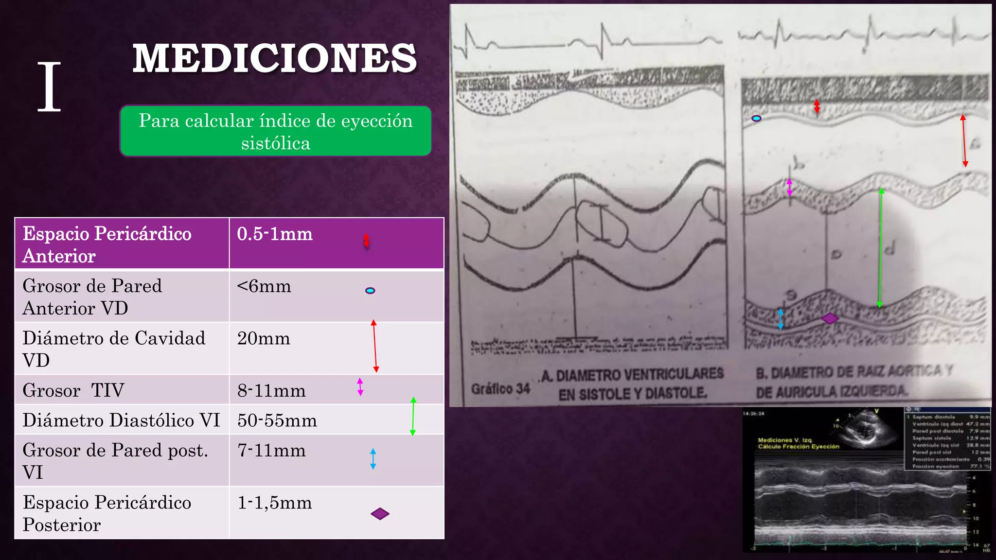 Ecocardiografia modo m | PPT