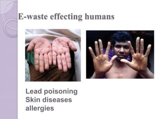 E-waste effecting humans

Lead poisoning
Skin diseases
allergies

 