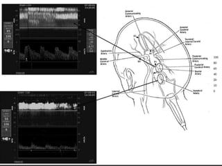 Avaliação primária na identificação dos vasos intracranianos________Profundidade de insonaçãoDireção de fluxo no dopplerVelocidade de fluxosPosição do probeDireção do fluxo no colorImagem dos vasos