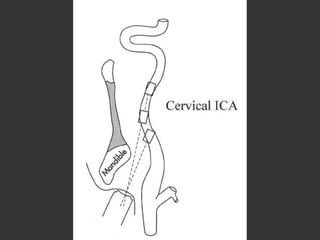 Janela transorbitária________Artéria oftálmicaSifão carotídeoJanela subocciptal__________Artéria vertebral