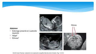ISUOG Guías Practicas: realización de la exploración ecográfica fetal del primer trimestre. Pag, 13, 2013
 
