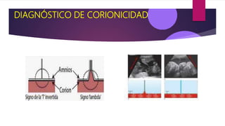 DIAGNÓSTICO DE CORIONICIDAD
 